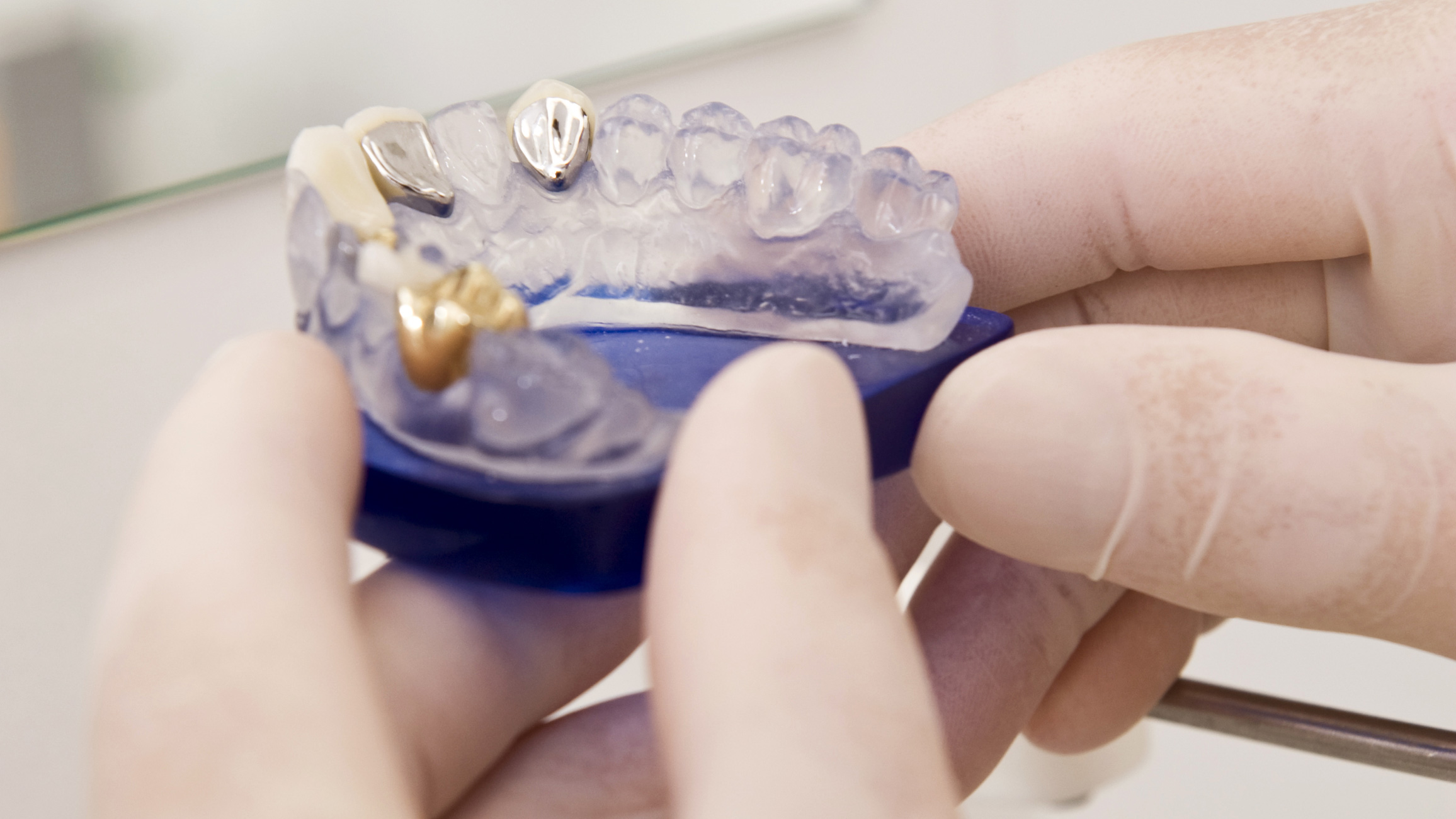 Zahnersatz - Zahnkrone